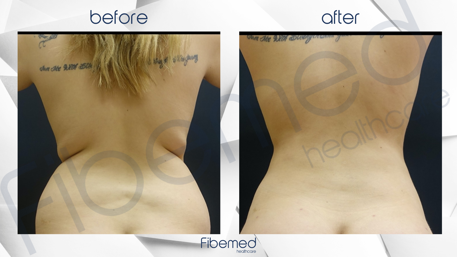 360 Liposuction in Turkey Fibemed Healthcare