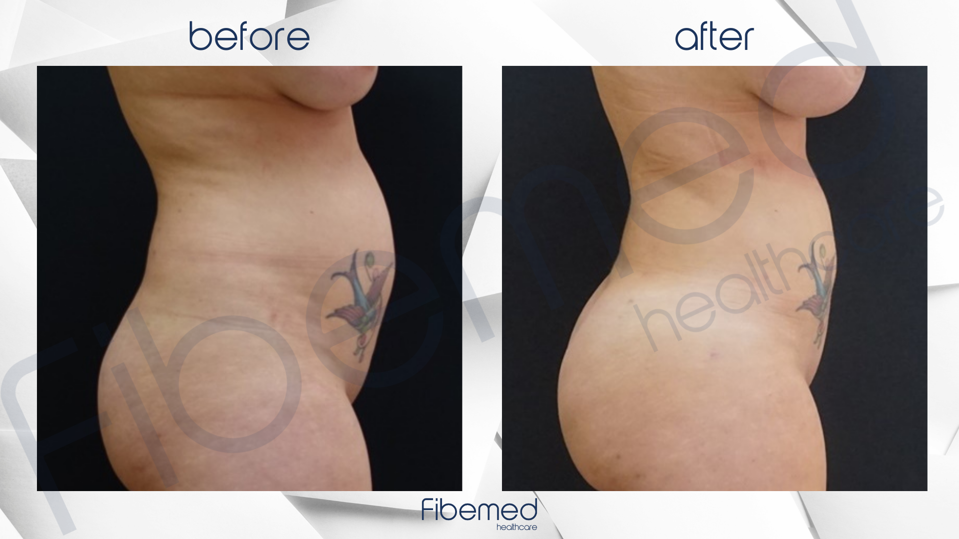 360 Liposuction in Turkey Fibemed Healthcare