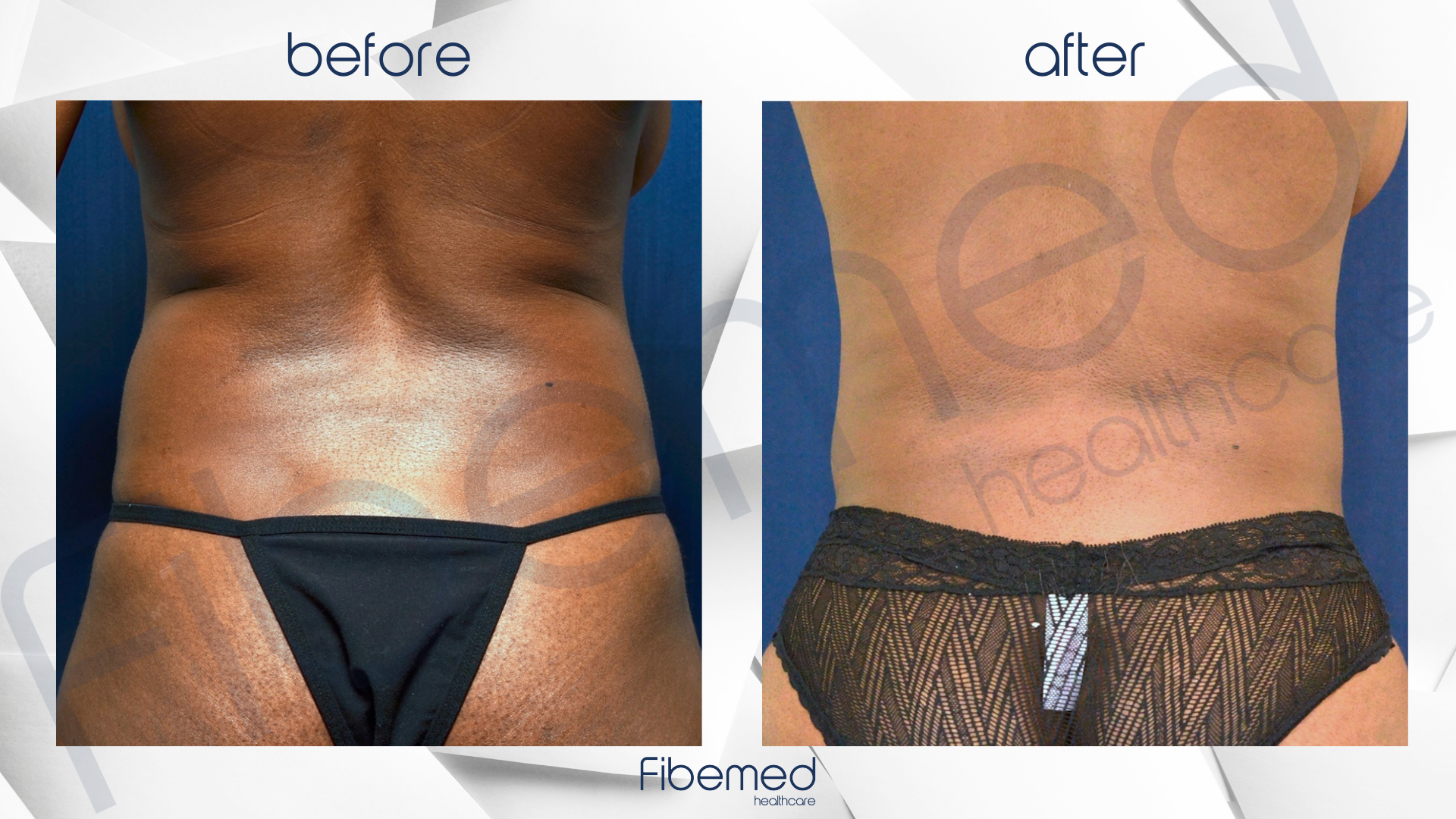 360 Liposuction in Turkey Fibemed Healthcare