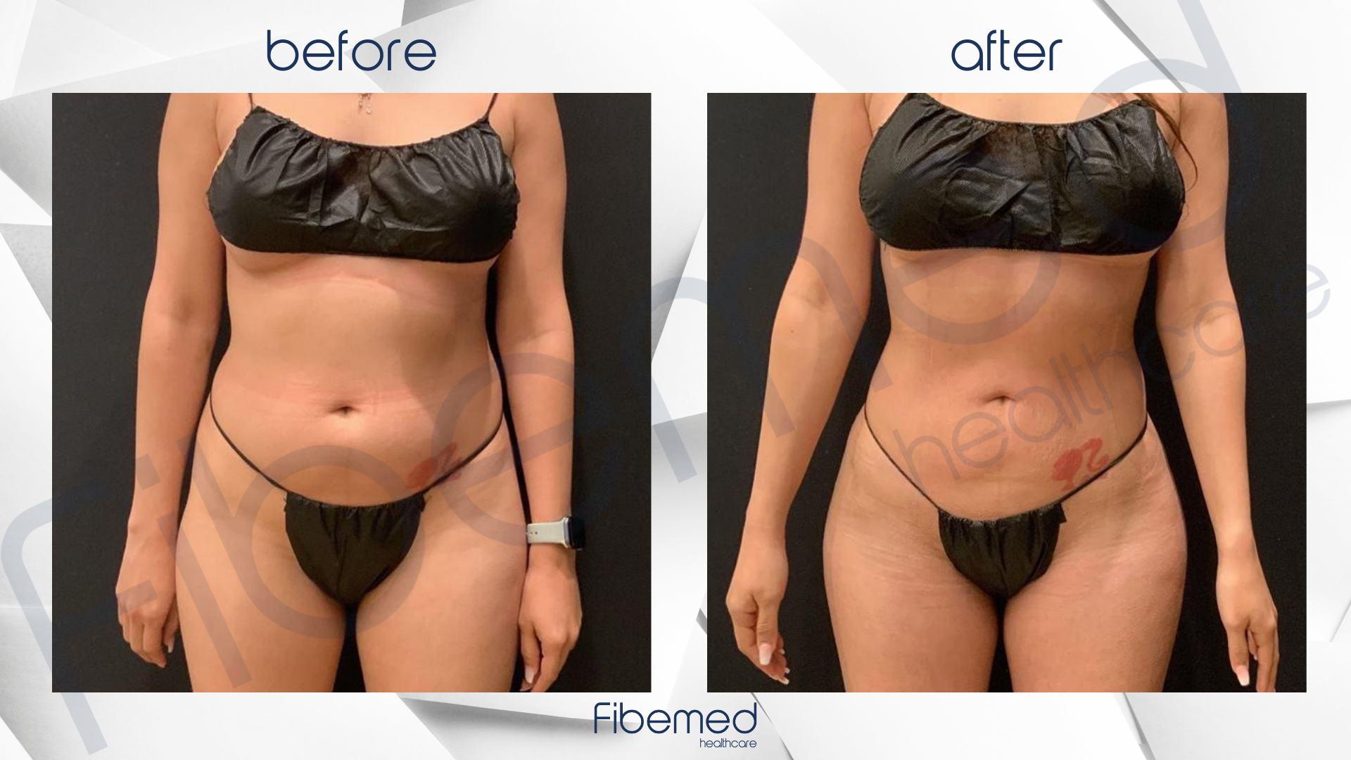 360 Liposuction in Turkey Fibemed Healthcare