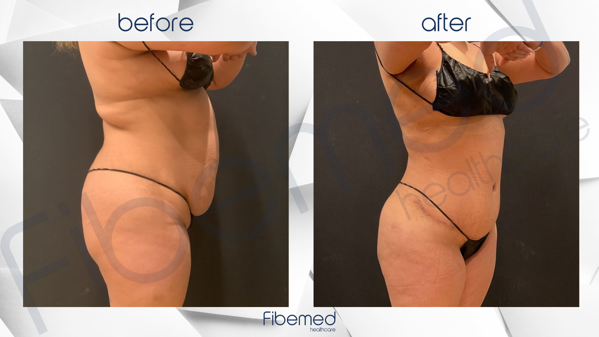 360 Liposuction in Turkey Fibemed Healthcare