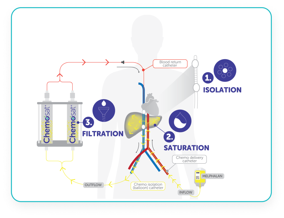 Chemosaturation Treatment in Turkey