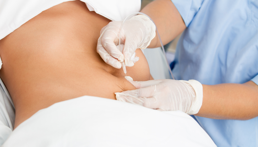 Intra-Abdominal-Surgery-turkey-fibemed-healthcare