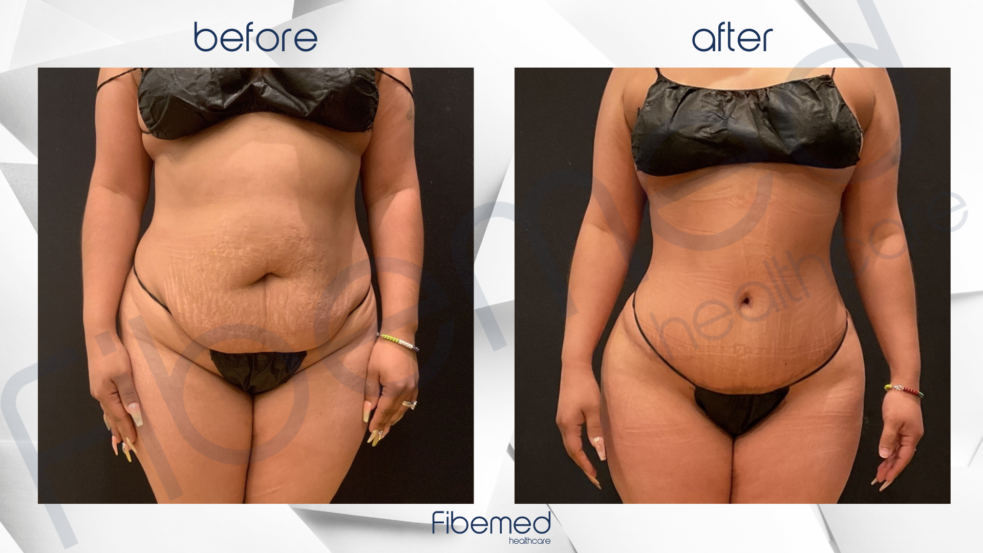 Mummy makeover deals