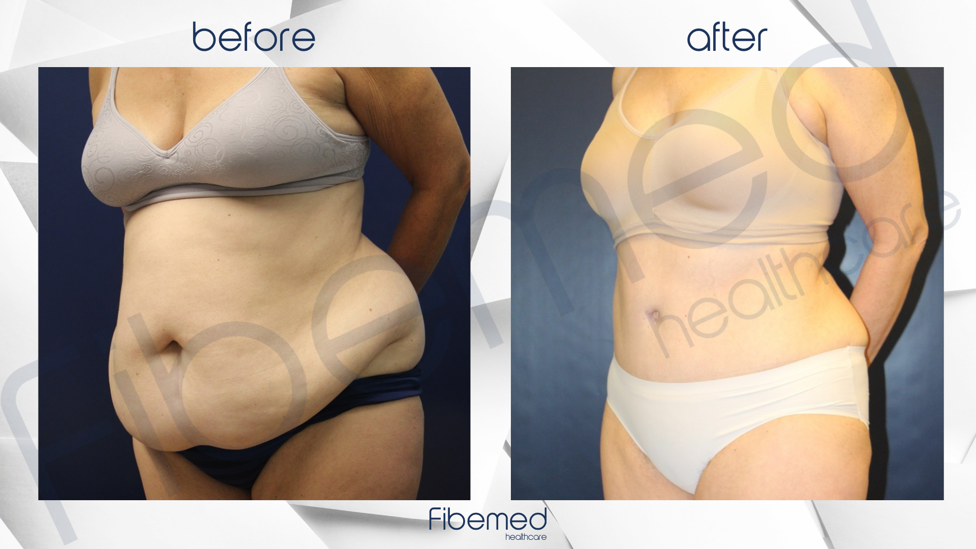 Mommy Makeover in Turkey Fibemed Healthcare