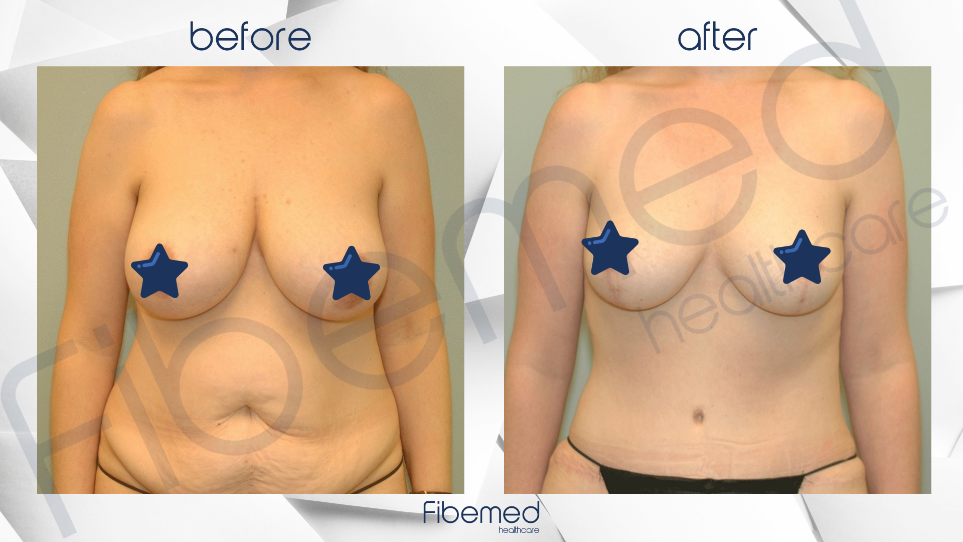 Breast Lift (with or without implants) in Turkey