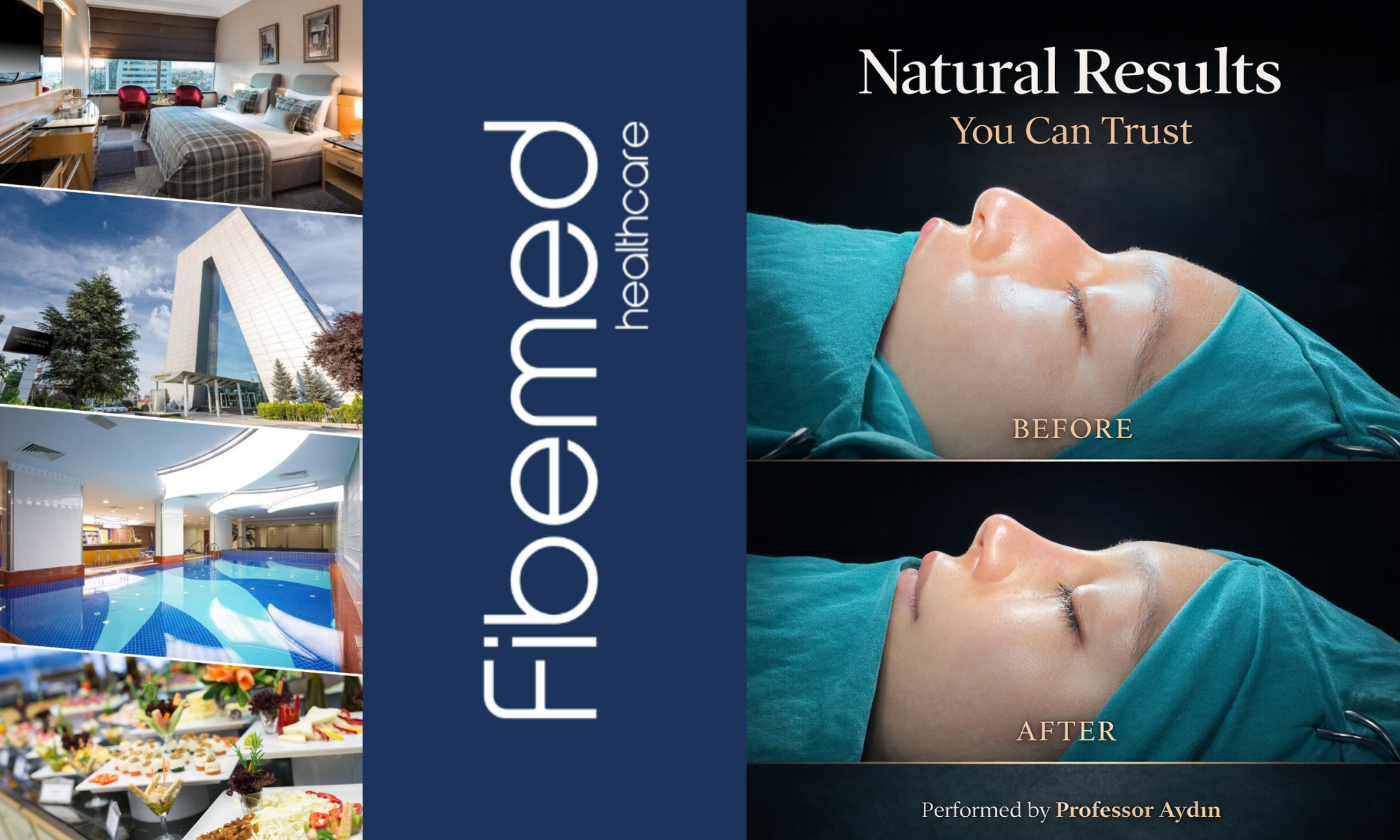 before and after rhinoplasty in turkey showing natural nose reshaping with balanced facial harmony